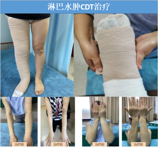 康复小组亮点照片1-淋巴水肿规范手法治疗.png